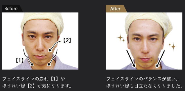 メンズTBCエステの施術前後の結果説明