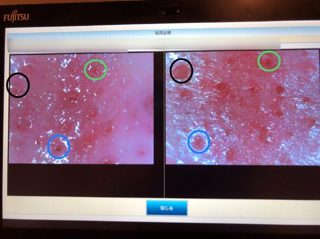 メンズTBC施術前後の毛穴の写真